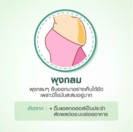 พุง ลักษณะ ต่างๆ-พุงกลม