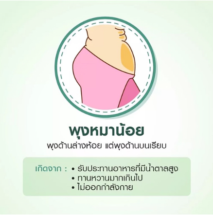 พุง ลักษณะ ต่างๆ-พุงหมาน้อย